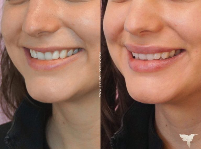 Skin by Lovely Lip Dermal Filler Before and After