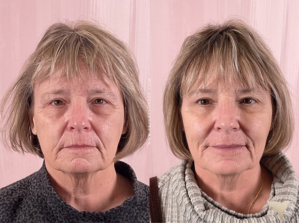 Liquid Facelift Dermal Filler Before and After in Lake Oswego, OR and Santa Monica, CA