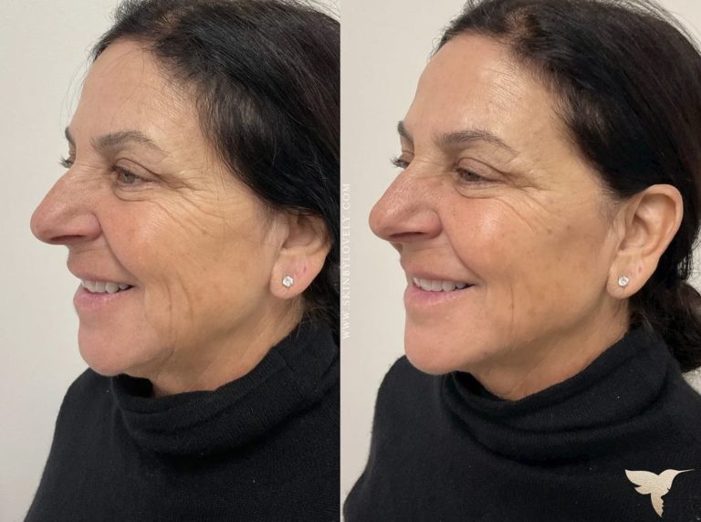 Liquid Facelift Dermal Fillers Before and After with Skin by Lovely