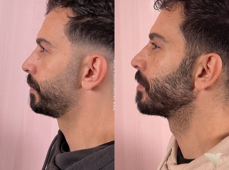 Male chin dermal fillers before and after with Skin by Lovely