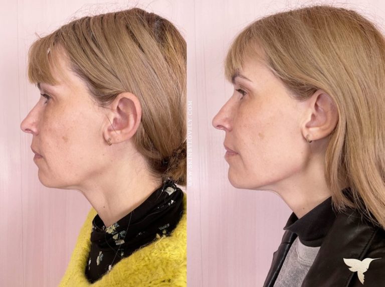 Juvederm Volux Dermal Filler Before and After at Skin by Lovely