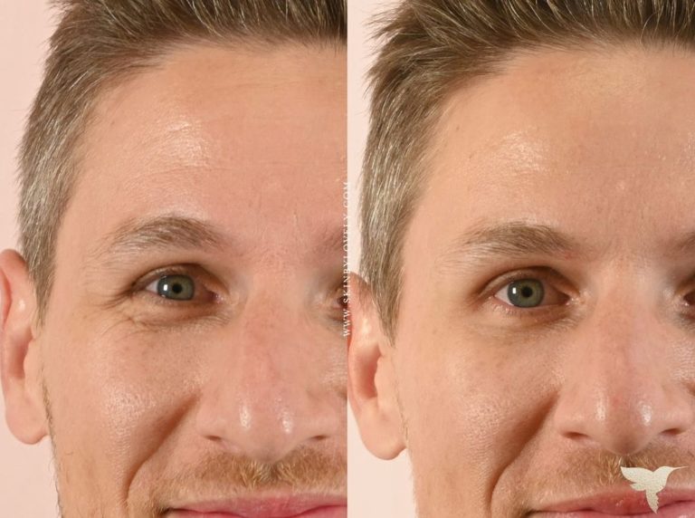 Male Wrinkle Relaxer Before and After from Lake Oswego, Oregon