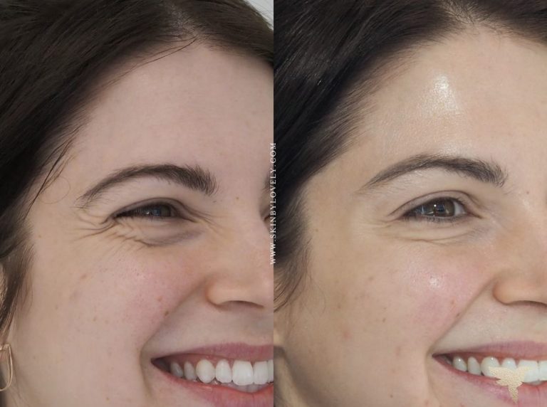 Wrinkle Relaxers Before and After from Skin by Lovely Camas