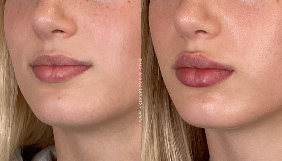 Lip Filler Results