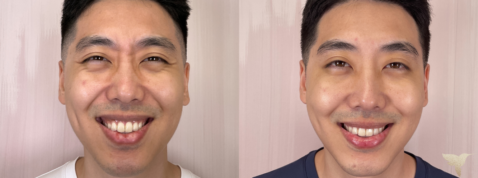 Botox Results