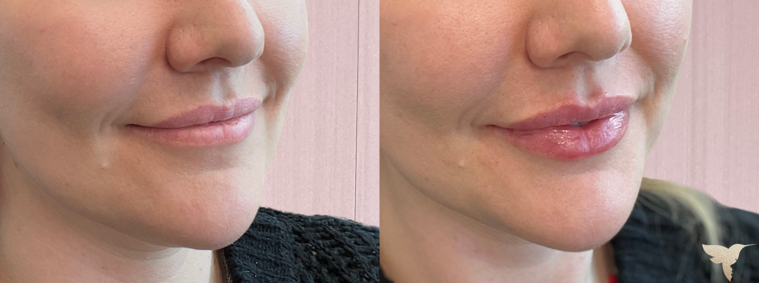 Lip filler results before and after