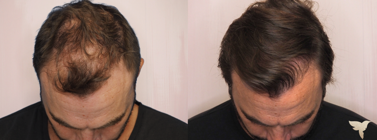 PRF Hair Restoration