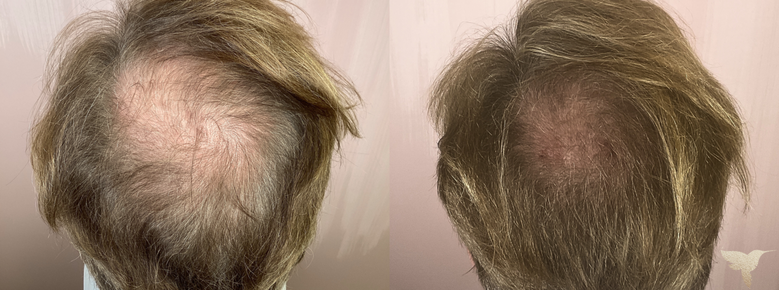 PRF Hair Restoration results