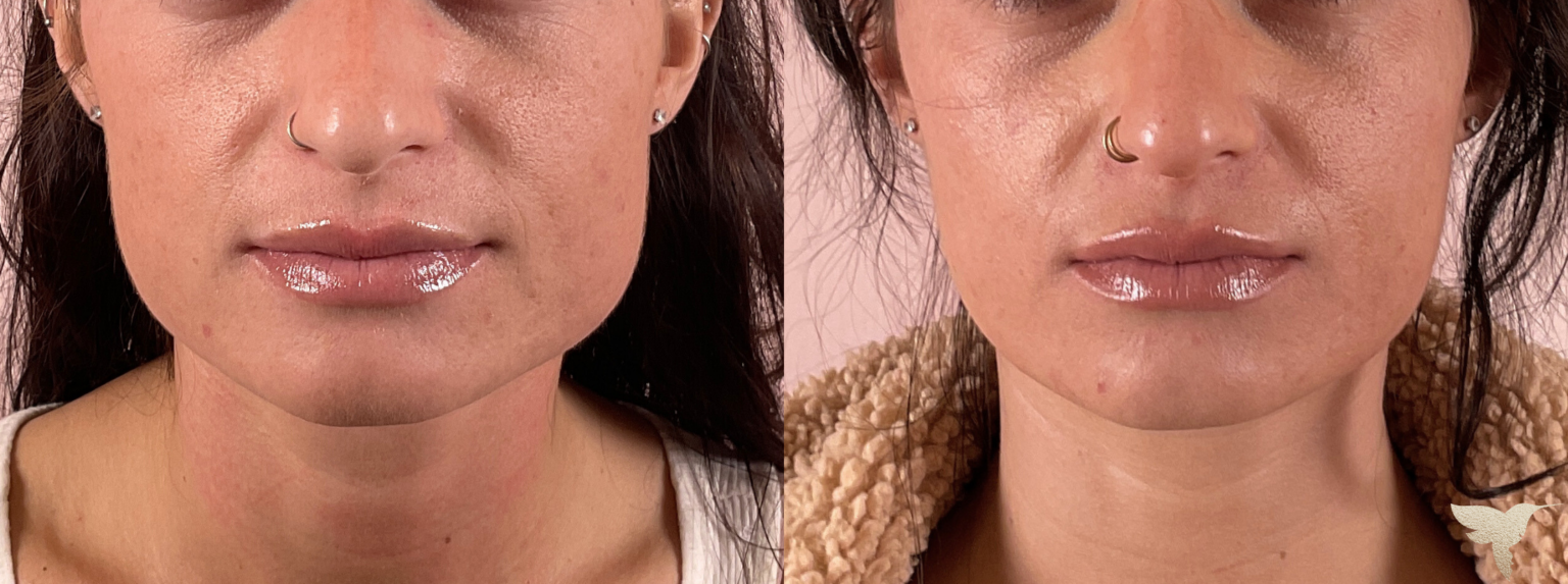 masseter botox results