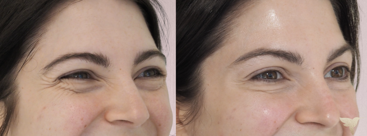 Dysport crows feet results