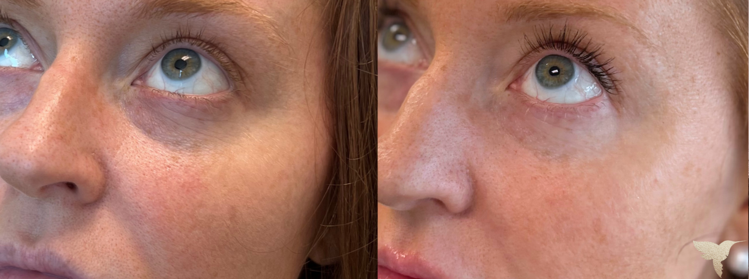 EZ Gel under eye results