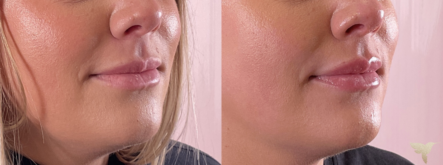 Lip Flip Results