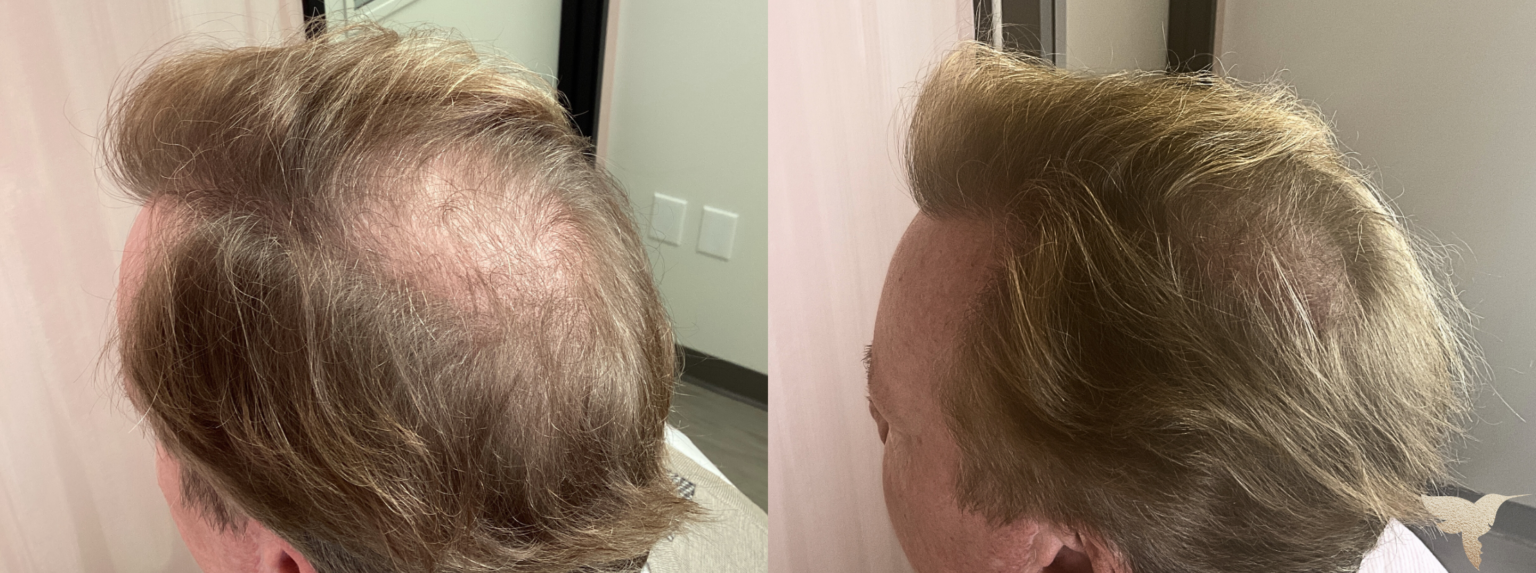PRF hair results