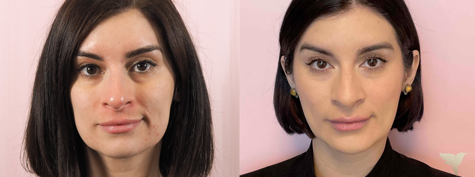 Sculptra results