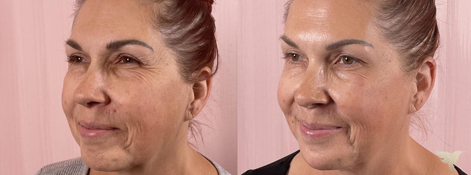 Sculptra results