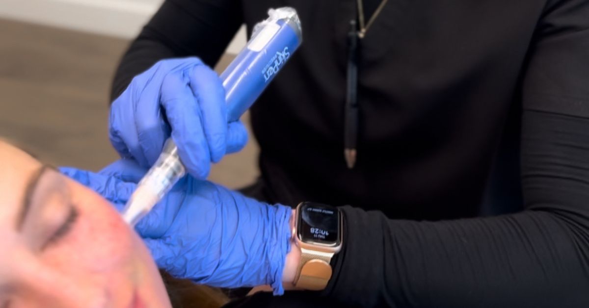 A look at the 3 depths of chemical peels and their benefits