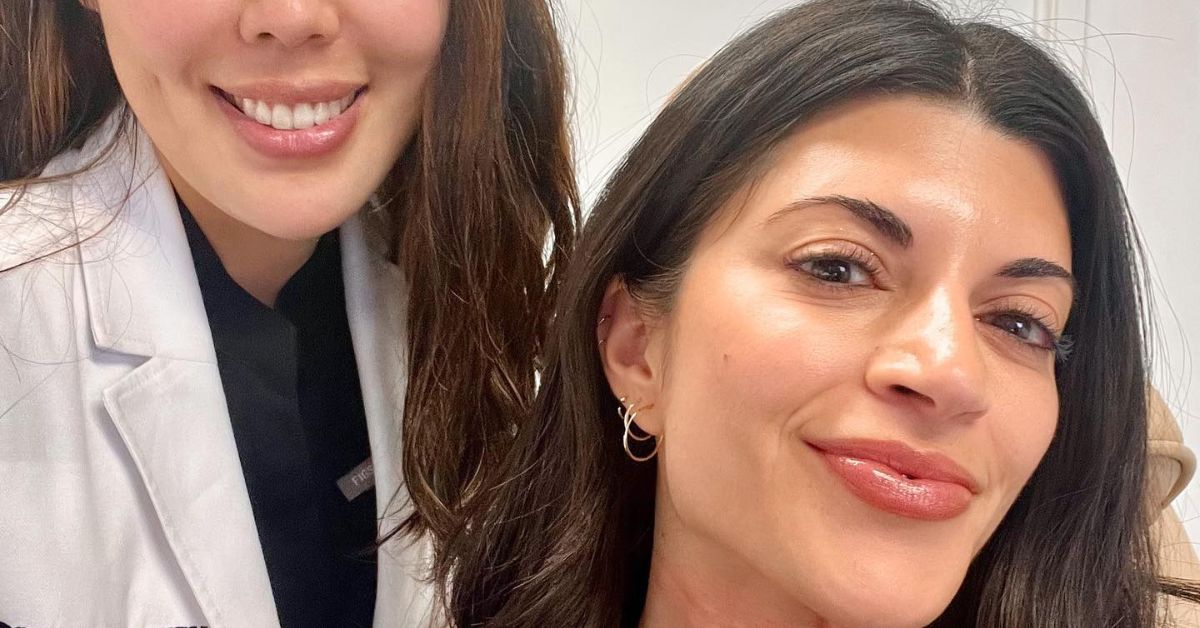 Are the effects of microneedling permanent?