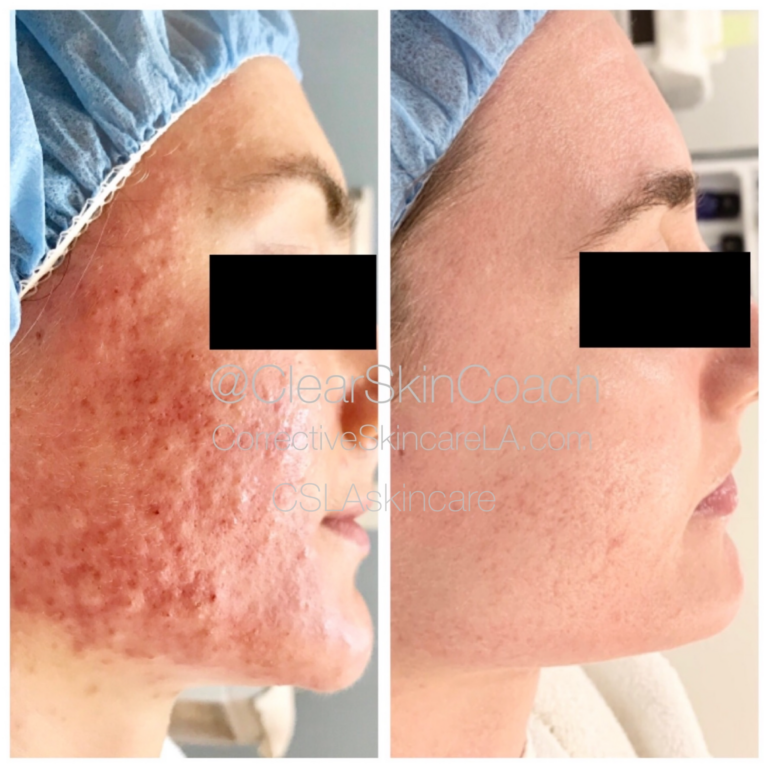 Corrective Skincare LA Facial Before and After