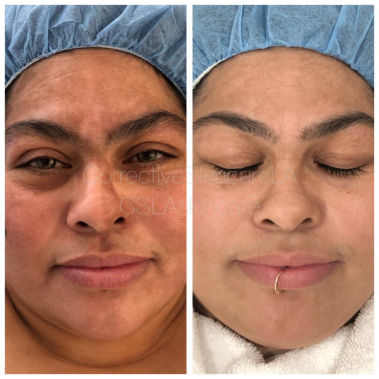 Corrective Skincare LA Facial Before and After