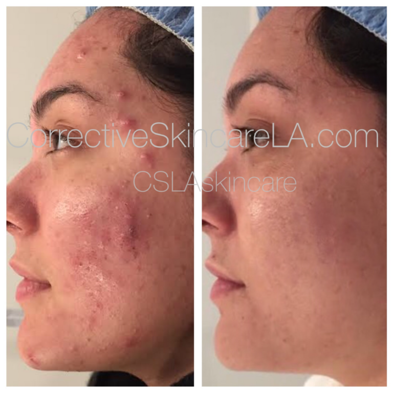 Corrective Skincare LA Facial Before and After
