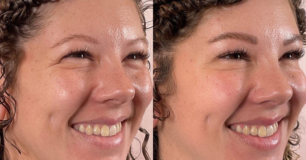 Microneedling Benefits: Glow in 1 Session
